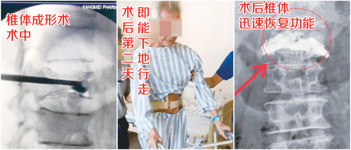 腰椎骨折卧床不起的84歲老伯在我院重獲新生