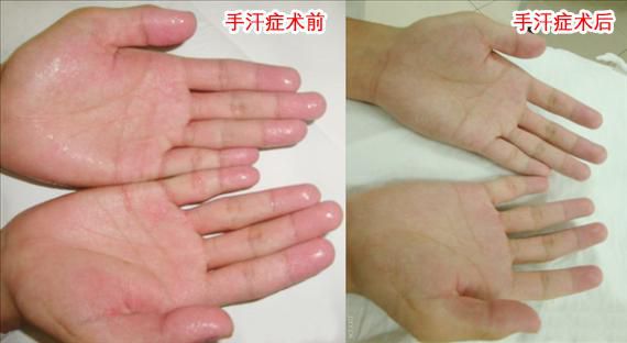 神奇的腔鏡微創手術，讓小夥子告别20餘年的“水手”